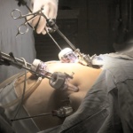 bariatric surgery procedures explained