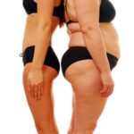 Know about bariatric surgery