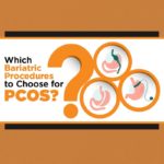 Which Bariatric Procedures to Choose for PCOS