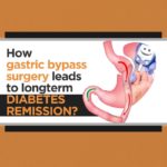 How gastric bypass surgery leads to long-term diabetes remission 1