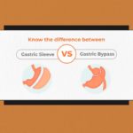 Know the difference between Gastric Sleeve vs Gastric Bypass 1