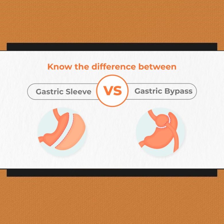 Know the difference between Gastric Sleeve vs Gastric Bypass 1